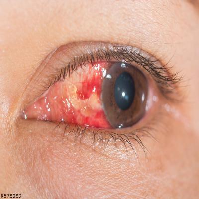 到,眼白发红充血主要是由于慢性刺激,病理性原因,眼部外伤,眼睛被压迫