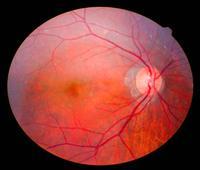 正常眼压青光眼怎样治疗 青光眼症候群如何用药