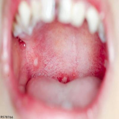 喉咙里长泡泡是什么病图片