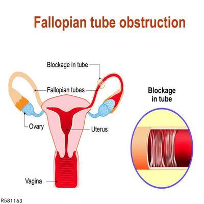 　输卵管堵塞可以试管婴儿怀孕吗