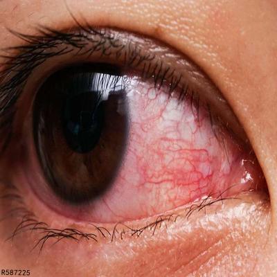 红眼病症状图片图片