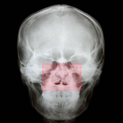 鼻骨骨折如何处理揭秘鼻骨骨折的正确处理方法 快速问医生