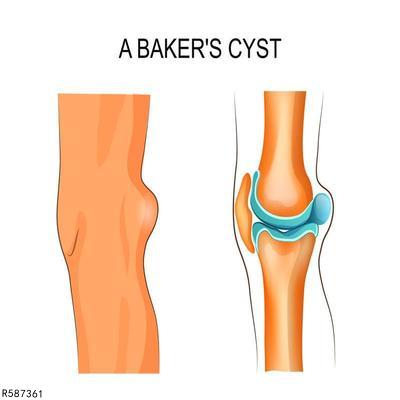 膝关节半月板损伤严重怎么治疗 膝关节半月板损伤 快速问医生