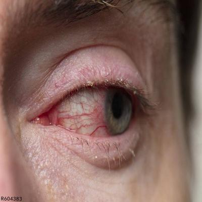 1,眼睑炎的典型性症状就是在眼睑部位,会有局限性的脓液积聚,并且会