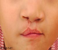 唇腭裂术前术后注意事项有哪些