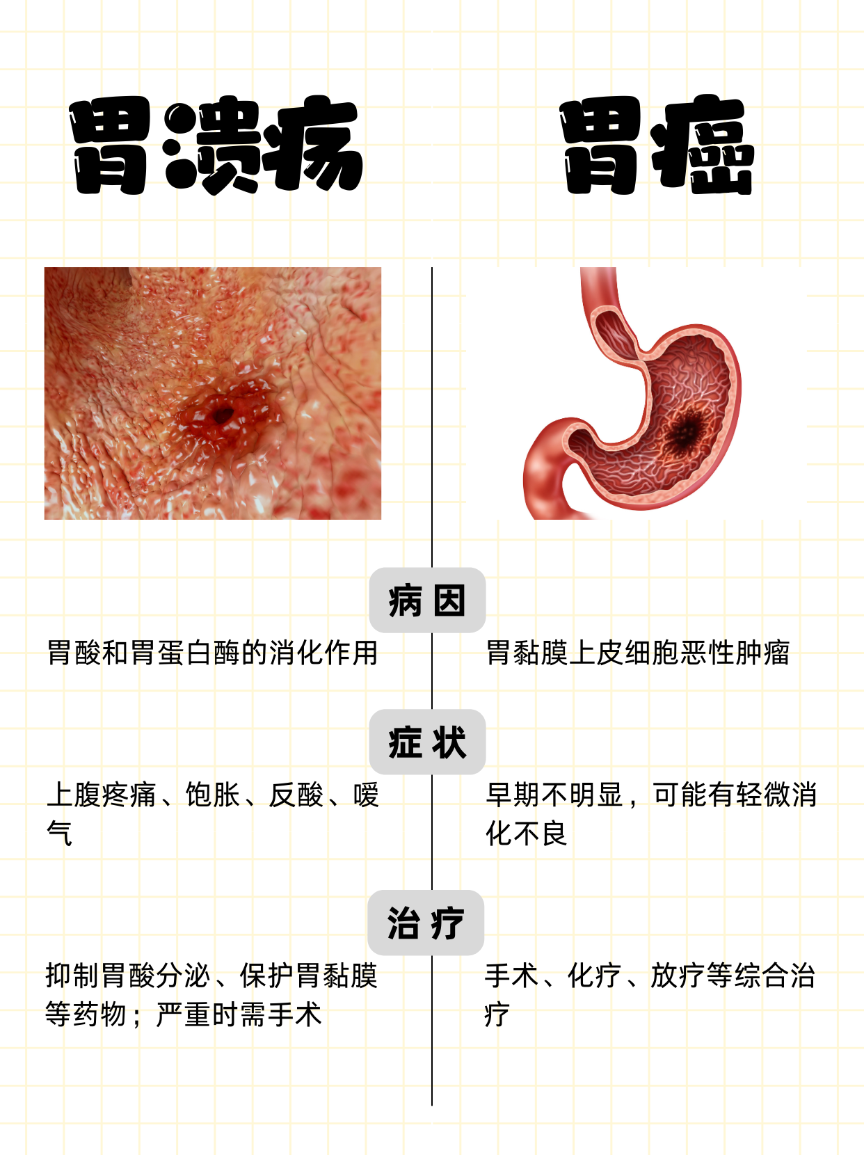 胃溃疡会癌变吗图片